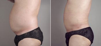 Male Liposuction Patient 14
