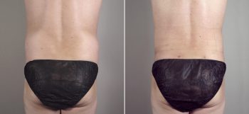 Male Liposuction Patient 14