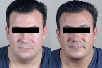 Male Neck Contouring Patient 6