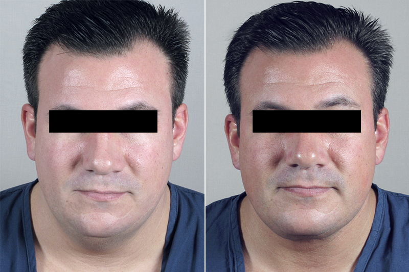 Male Neck Contouring Patient 6