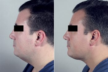 Male Neck Contouring Patient 6