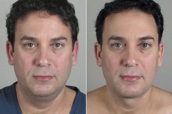 Male Neck Contouring Patient 5