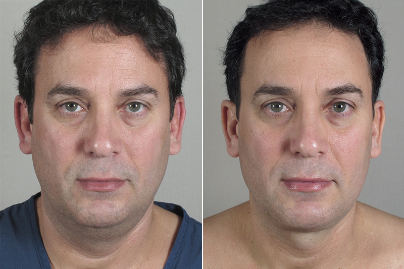 Male Neck Contouring Patient 5