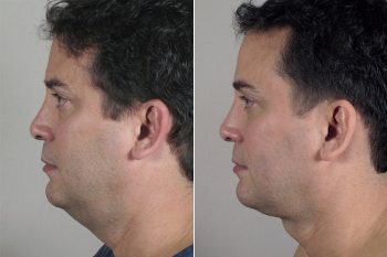 Male Neck Contouring Patient 5