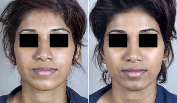 Rhinoplasty Patient 26