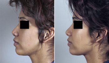 Rhinoplasty Patient 26