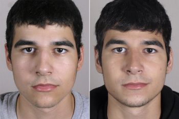 Male Rhinoplasty Patient 12
