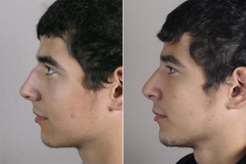 Male Rhinoplasty Patient 12