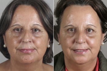 Rhinoplasty Patient 27