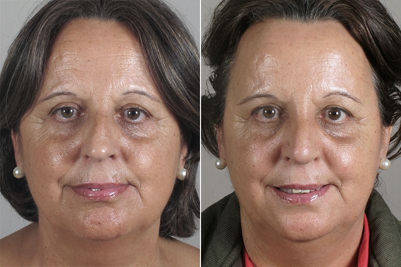 Rhinoplasty Patient 27