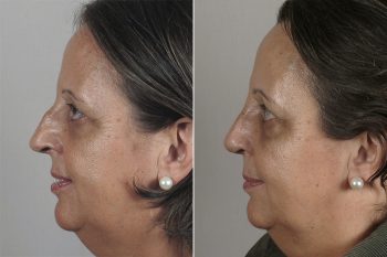 Rhinoplasty Patient 27