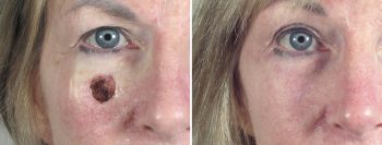 Skin Cancer Treatment Patient 23