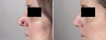 Skin Cancer Treatment Patient 24