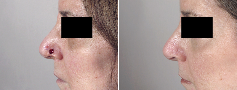 Skin Cancer Treatment Patient 24