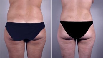 Abdominal Liposuction Patient 7