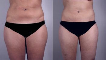Abdominal Liposuction Patient 7