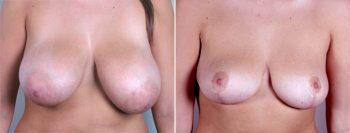 Abdominal Liposuction Patient 7