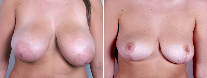 Abdominal Liposuction Patient 7