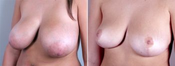 Abdominal Liposuction Patient 7