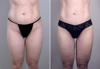 Abdominal Liposuction Patient 1