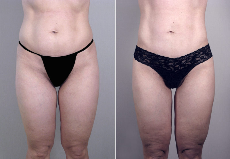 Abdominal Liposuction Patient 1