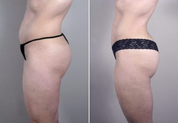Abdominal Liposuction Patient 1