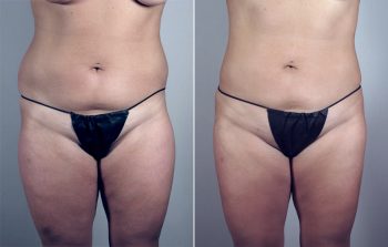 Abdominal Liposuction Patient 10