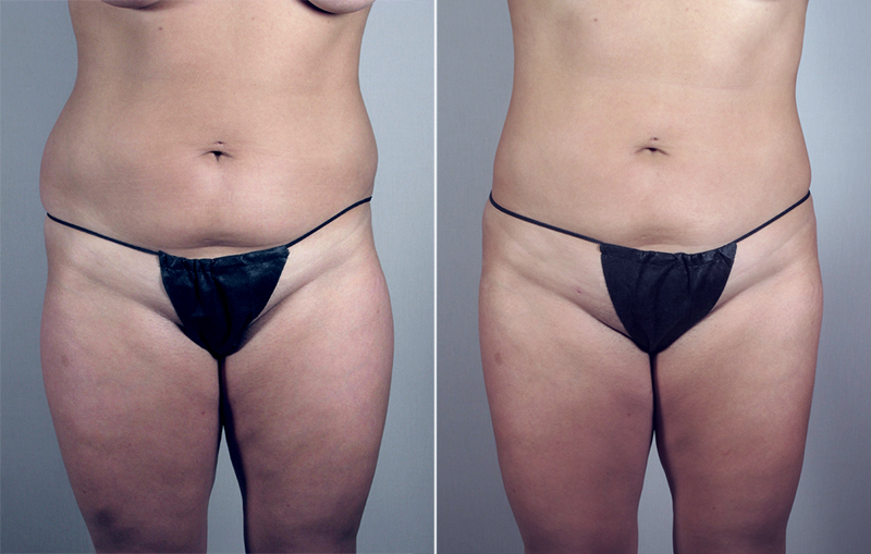 Abdominal Liposuction Patient 10