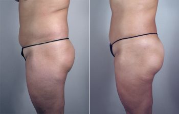 Abdominal Liposuction Patient 10