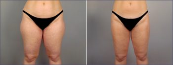 Abdominal Liposuction Patient 11