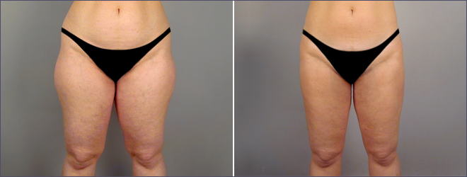 Abdominal Liposuction Patient 11