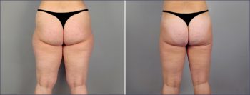 Abdominal Liposuction Patient 11
