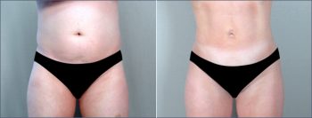 Abdominal Liposuction Patient 4