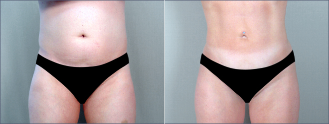 Abdominal Liposuction Patient 4