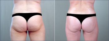 Abdominal Liposuction Patient 4