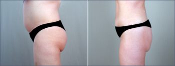 Abdominal Liposuction Patient 4