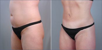 Abdominal Liposuction Patient 4