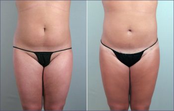 Abdominal Liposuction Patient 5
