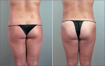 Abdominal Liposuction Patient 5