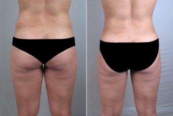 Abdominal Liposuction Patient 6