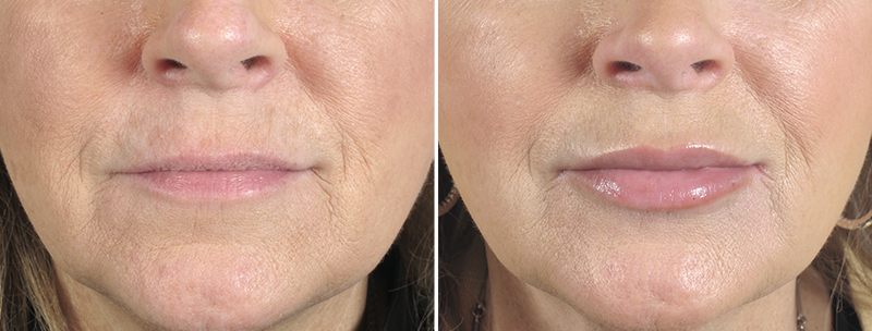 Lip Enhancement Patient 4