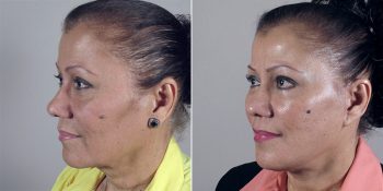Facelift Patient 15