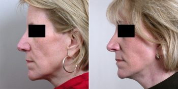 Facelift Patient 16