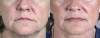 Neck Liposuction Patient 6