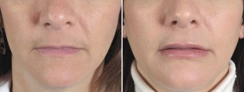 Lip Enhancement Patient 5