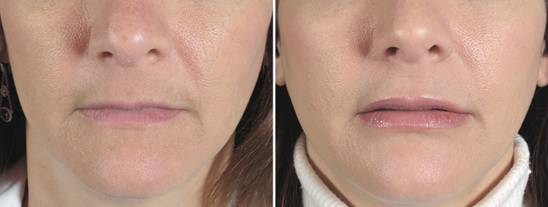 Lip Enhancement Patient 5