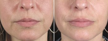 Lip Enhancement Patient 6