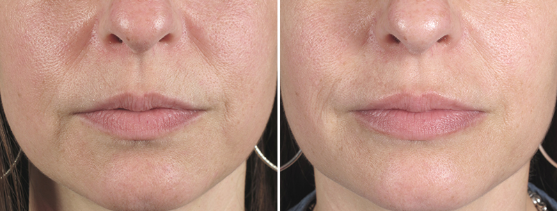 Lip Enhancement Patient 6