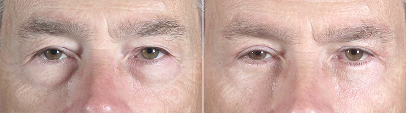 Male Eyelid Lift Patient 8