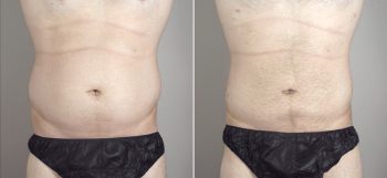 Male Liposuction Patient 16